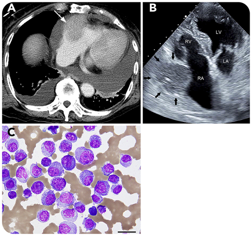 A 79-year-old woman visited our hospital because of back pain. Laboratory examination showed monoclonal λ light chains in the serum, and a population of 60% CD138+ plasma cells was found on bone marrow biopsy. Karyotype was normal, and whole-body computed tomography (CT) found no extramedullary lesions. She was diagnosed with immunoglobulin A λ-type multiple myeloma (MM), classified as stage 2 according to the Revised International Staging System; she started treatment with bortezomib plus dexamethasone and achieved complete response. One year later, multiple tumors in her right mammary gland were detected on CT. Mammary gland biopsy found plasmacytoma, resulting in a diagnosis of extramedullary lesions in MM. Four years after first visit, she was admitted with heart failure. Contrast-enhanced CT (panel A) and echocardiography (panel B; LA, left atrium; LV, left ventricle; RA, right atrium; RV, right ventricle) revealed a moderate amount of pericardial effusion and a mass (3.8 × 4.5 cm) in the right atrial wall (white arrow in panel A and black arrows in panel B) consistent with cardiac tamponade; pericardial drainage was then performed. Cytology for the bloody pericardial effusion showed clusters of plasma cells (panel C; periodic acid Schiff stain; original magnification ×400), indicating an extramedullary lesion to the pericardium. Fluorescence in situ hybridization from the bone marrow detected no cytogenetic abnormality. Although daratumumab, carfilzomib, and pomalidomide were administered, the mass enlarged, and she died thereafter.