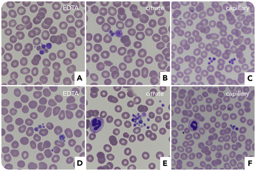 A 63-year-old woman with a history of immune thrombocytopenic purpura (ITP) was referred for subarachnoid hemorrhage and subdural hematoma after a fall. At admission, she had 24 × 109/L platelets with aggregates on blood smears (EDTA, citrate, and capillary) and large platelets (panels A-C, May-Grünwald Giemsa stain, original magnification ×60). IV immunoglobulins (IVIGs) and corticosteroids were ineffective, while platelet concentrates showed a transient efficacy. Because of the ITP, eltrombopag was prescribed, which normalized platelet counts and stopped the hemorrhage. Incidentally, her sister revealed that she also was suspected of ITP and that there was a notion of von Willebrand disease (VWD) in the family. She was thus also tested, which disclosed severe thrombocytopenia (48 × 109/L platelets) with aggregates (panels D-F, May-Grünwald Giemsa stain, original magnification ×60), factor VIII:C 1.02 IU/mL, VWF:ristocetin cofactor 0.4 IU/mL, and VWF:antigen 0.8 IU/mL (ratio VWF:ristocetin cofactor/VWF:antigen, 0.5).