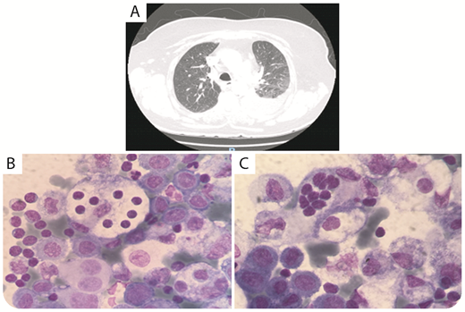 A 79-year-old woman was admitted to the hospital for dyspnea, dry cough, and left-sided chest pain. Her medical history included coronary artery disease, hypertension, and hypothyroidism. No palpable lymphadenopathy or organomegaly was noted on physical examination. Her chest radiograph showed left lower lobe atelectasis and pleural effusion, and her chest computed tomography scan showed significant left-sided pleural effusion with associated volume loss (panel A). Pleural fluid analysis showed proliferating histiocytes that represented 40% of the nucleated cells, with 15% exhibiting emperipolesis by engulfing intact lymphocytes (panels B-C; hematoxylin and eosin stain, original magnification ×1000). They were intermixed with mesothelial cells in a background rich in lymphocytes. Histiocytes were positive for CD68 and S100 and negative for CD1a. No feature indicative of malignant lymphoproliferative disorder was detected by flow cytometry. Findings were consistent with an extranodal variant of Rosai-Dorfman disease. The patient was treated with left pleurodesis and oral prednisone, showing significant improvement. / Rosai-Dorfman disease, also known as sinus histiocytosis with massive lymphadenopathy, is a benign proliferation of histiocytes with no known pathogenesis. It primarily affects cervical lymph nodes with possible involvement of extranodal tissues. Lung involvement occurs in <3% of cases with extranodal disease. Although clonality could not be established in the reported case, somatic mutations affecting NRAS, KRAS, MAP2K, and ARAF genes were found.
