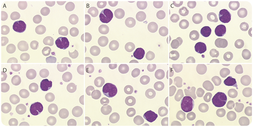 A 1-month-old child was admitted with a cough of 1 week’s duration. The blood count revealed marked leukocytosis (45.9 × 109/L) with a predominance of lymphocytes (76%). The lymphocytes were polymorphous but many had a cleft nucleus (panels A-F; May-Grünwald-Giemsa stain, original magnification ×100), suggestive of lymphoma (eg, follicular lymphoma or Sézary syndrome). This cytological presentation together with the clinical findings were typical of “malignant whooping cough.” Positive polymerase chain reaction testing for Bordetella pertussis, carried out on a nasopharyngeal swab, confirmed the diagnosis. / Pertussis (whooping cough) is an acute bacterial disease of the airways caused by a gram-negative bacterium, B pertussis. Its transmission is airborne and highly contagious. Lymphocytosis is mainly seen in children and is an indicator of the severity of the infection, with a risk of pulmonary leukostasis when the counts exceed 100 × 109/L. Whooping cough is a life-threatening disease, particularly in infants younger than 3 months of age. In areas with low rates of vaccination, immunocompromised patients and young infants are at particular risk from multiple highly contagious infections such as measles. Even in areas with high rates, immunity to pertussis wanes and booster shots are needed to ensure adequate immunity. Women and/or those with infants must be strongly encouraged to be vaccinated to prevent infection in the vulnerable.
