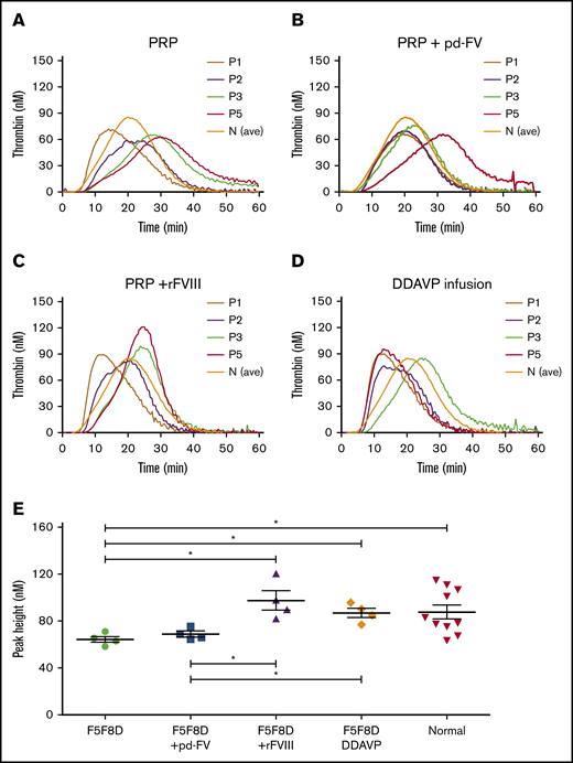 Effect of normalized FV or FVIII on thrombin generation in 4 F5F8D PRPs. (A) Thrombin generation in PRP of 4 F5F8D patients. (B) Thrombin generation in 4 F5F8D PRPs with addition of FV to bring the FV level to 100 IU/dL. (C) Thrombin generation in 4 F5F8D PRPs with addition of FVIII to bring the FVIII level to 100 IU/dL. (D) Thrombin generation in PRP of 4 F5F8D patients received 0.5 hour after DDAVP infusion. The average TGA curve of 10 normal PRPs is presented for reference. (E) PH values of thrombin generation were compared among the different groups mentioned above. *P < .05.