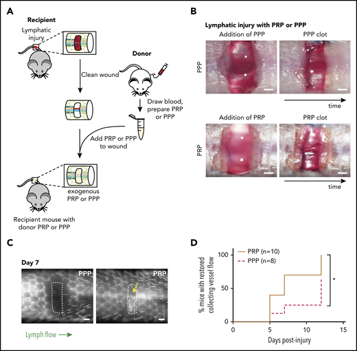 Platelets promote lymphangiogenesis after wounding. (A) Schematic of PRP or PPP treatment to tail injury. After lymphatic injury in the recipient mouse, the injury site is cleaned and PRP or PPP prepared from blood from a donor mouse added. (B) Images showing application of PRP or PPP to the tail injury site. (C) Representative tail lymphangiography across the injury site on day 7 after tail lymphatic injury in wild-type mice to which PRP or PPP was added to the injury site. Note that flow across collecting lymphatic vessels is not restored in the PPP-treated animal, but is restored in the PRP-treated animal (yellow arrow). (D) Healing curves for restoration of lymphatic flow after addition of PRP or PPP to the injury site. Scale bars = 500 µm. *P < .05.