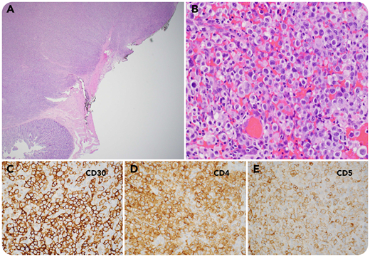 A 34-year-old man with a 3-month history of HIV (CD4, 191 cells per µL) presented to the emergency department with worsening intermittent abdominal pain, black stools, and night sweats for 1 week. A computed tomography scan showed continued intussusception in the jejunum. Exploratory laparotomy with small bowel resection was performed. Multiple masses (up to 3 cm) were noted in the ileum and jejunum, with full thickness involvement on gross examination (panel A; 2× objective; hematoxylin and eosin stain). Histology showed sheets of large anaplastic tumor cells involving both the small bowel and regional lymph nodes (panel B; 40× objective; hematoxylin and eosin stain). By immunohistochemistry (panels C-E; 40× objective), these cells were positive for CD30, CD4, CD5, CD2, CD7, granzyme B, perforin, and TIA-1 and negative for CD3, CD8, ALK1, EMA, HHV-8, LMP1, CD15, CD20, PAX5, CD138, and CD56, with EBER negativity by in situ hybridization (ISH). By fluorescence ISH, the cells were negative for DUSP22 and TP63 gene rearrangement. This case represented HIV-associated ALK− anaplastic large cell lymphoma (ALCL) without DUSP22 or TP63 gene rearrangement.