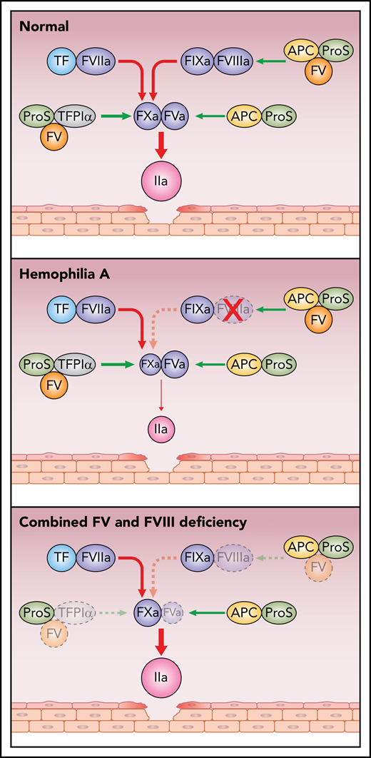 Simplified scheme of pro- and anticoagulant reactions in health, in hemophilia A, and in combined FV and FVIII deficiency. Damage to the vessel wall results in activation of coagulation via FVIIaTF. FVIIaTF and FIXaFVIIIa activate FX; FXa then binds to FVa and activates prothrombin to thrombin. The anticoagulant functions of FV include being a carrier to TFPIα and a synergistic cofactor with protein S (ProS) to TFPIα as well as to APC. In health, the pro- and anticoagulant mechanisms are in balance. In contrast, in hemophilia A, the balance is shifted to anticoagulation with little thrombin generated. In F5F8D, because the anticoagulant functions of FV, TFPIα, and protein S are deficient, the low levels of FV and FVIII are sufficient to efficiently generate thrombin. Red arrows, procoagulant reactions; green arrows, anticoagulant reactions.