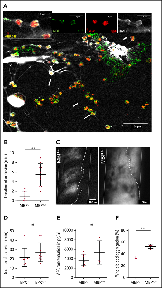 Major basic protein on EETs activates platelets. (A) Eosinophils activated in vitro by platelets (red) formed EETs containing MBP (green) and DNA (white, DAPI). On EETs, MBP and platelets colocalize (arrows) as shown in higher magnification in the insets at the top of the panel. Images from confocal microscopy representative of 3 experiments. (B) Thrombus formation in MBP−/− mice (n = 8) is significantly impaired compared with thrombus formation in MBP+/+ littermates (n = 10). (C) Representative images of platelet aggregation (gray area, dotted line) in the carotid artery (white lines) of MBP−/− and normal thrombus development in MBP+/+ mice 20 minutes after endothelial injury. (Recanalization is marked by dotted line). (D) EPX−/− mice (n = 8) as well as EPX+/+ (n = 10) mice showed occlusive thrombus formation. (E) APC concentrations in plasma of MBP+/+ (n = 5) and MBP−/− (n = 8) did not show any differences after arterial thrombosis. (F) Platelet aggregation induced by ADP in IL-5 and eotaxin-treated whole blood of female MBP−/− mice (n = 4) was significantly decreased compared with that in wild-type mice (n = 3). For panels B and D-F, data are mean ± SD. ***P < .001.