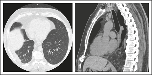 (A) The patient in clinical case 1 with several episodes of severe autoimmune hemolytic anemia was only diagnosed with CVID after he had bacterial pneumonia and developed an empyema. (B) Lateral view shows the posterior empyema collection.