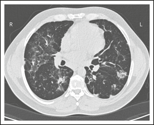 The patient in clinical case 2 had a slow decline in lung function due to his immune defect, but this was assumed to be due to sarcoidosis. Chest computed tomography showed ground-glass opacities with numerous nodules, hilar lymphadenopathy, and bronchiectatic changes. With granuloma on biopsy, these changes were consistent with granulomatous lymphocytic interstitial lung disease.