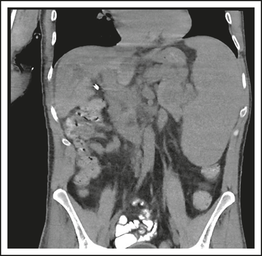 The patient in clinical case 3 was concerned because after he received chemotherapy for a presumed lymphoma, his spleen remained large. However, this is typical in patients with CVID.