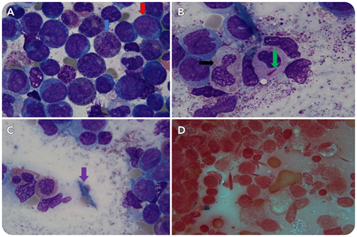 A 35-year-old man presented with weakness, dyspnea, fevers, and mucosal bleeding. Complete blood count showed normocytic anemia (5.0 g/dL), severe thrombocytopenia (6000/mm3), and circulating blasts. Bone marrow core biopsy was hypercellular, with 42% blasts and 14% eosinophils enumerated on the aspirate with a marrow flow cytometry showing CD34, CD117, and myeloperoxidase positive blasts, consistent with the diagnosis of acute myeloid leukemia (AML).