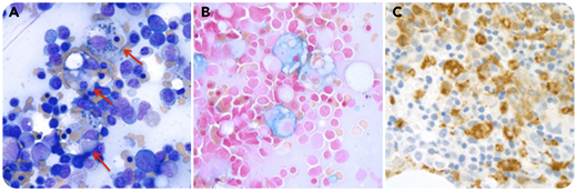 A 43-year-old male presenting with jaundice had a hemoglobin (Hb) of 4 g/dL, platelet count of 153 × 109/L, total bilirubin of 6.1 mg/dL with indirect bilirubin of 5.1 mg/dL, lactate dehydrogenase of 545 IU/L, and haptoglobin of <8 mg/d. Peripheral smear showed spherocytes. The direct antiglobulin test result (immunoglobulin G and C3) was positive, and an indirect antiglobulin test confirmed autoimmune hemolytic anemia (AIHA). The absolute reticulocyte count was 0.1%. After no improvement on prednisone, IV immunoglobulin and rituximab were added due to an ongoing need for transfusions. Bone marrow (BM) aspirate showed erythroid hyperplasia and phagocytosis of just erythroid precursors by macrophages (panel A, original magnification ×100, Wright-Giemsa stain; panel B, original magnification ×100, Prussian blue for iron). BM biopsy showed diffusely increased macrophages (panel C, original magnification ×100, CD68 immunohistochemical stain) but did not meet diagnostic criteria for hemophagocytic lymphohistiocytosis, and no mutations associated with familial hemophagocytic lymphohistiocytosis were found. The Hb stabilized around 13g/dL, with other counts stable.