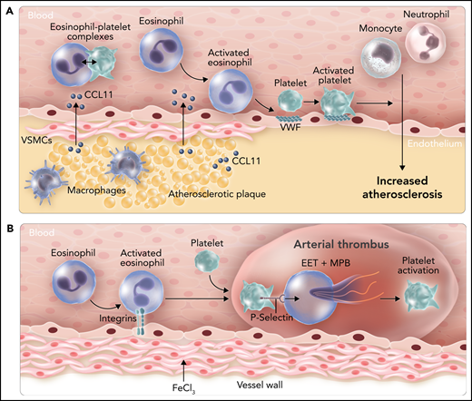 Roles of eosinophils in atherosclerosis and arterial thrombosis in mice. (A) Expression of the chemoattractant CCL11 by cells within atherosclerotic plaques leads to the recruitment of eosinophils. Binding of eosinophils to the endothelium leads to surface expression of von Willebrand factor (VWF) and binding and activation of platelets that enhance leukocyte migration into the vessel wall. CCL11 also activates eosinophils and increases levels of circulating eosinophil-platelet aggregates. (B) Administration of FeCl3 to the outside of the carotid artery leads to integrin-dependent binding of eosinophils. P-selectin–dependent platelet binding to eosinophils induces the release of EETs and MBP, which enhance platelet activation. VSMC, vascular smooth muscle cell. Professional illustration by Somersault18:24.