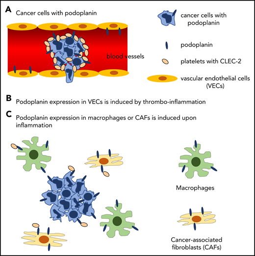 Hypothetical molecular mechanisms by which podoplanin induces cancer-associated thrombosis. (A) Podoplanin expressed on the surface of cancer cells activates platelets by binding to platelet CLEC-2 in the bloodstream. (B) Thromboinflammation induces expression of podoplanin in vascular endothelial cells, where podoplanin is not expressed in physiological status. (C) Podoplanin expression is induced in inflammatory macrophages and cancer-associated fibroblasts by inflammatory cytokines, although direct evidence shows that podoplanin in these cells activates platelets.