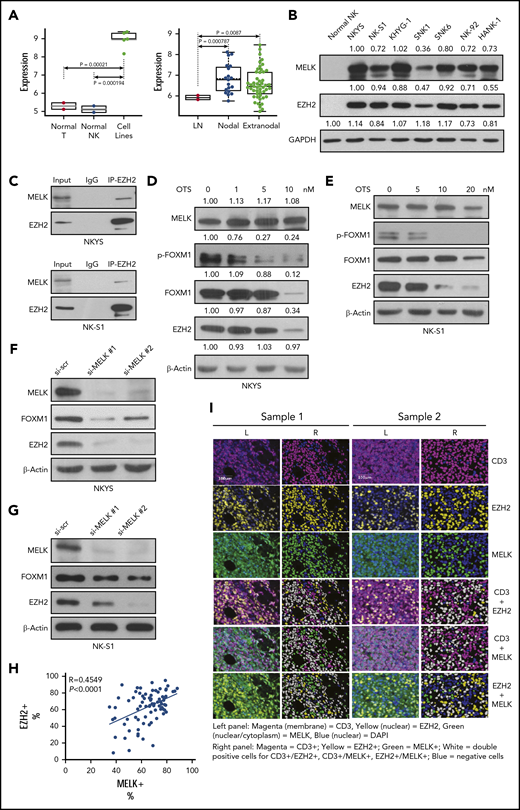 Overexpressed MELK correlates with EZH2 expression in NKTL. (A) Gene expression profiling data showing MELK expression in NKTL cell lines and patient samples of NKTL (extranodal) and EBV+ peripheral T-cell lymphoma (nodal) cases. (B) Expression of MELK and EZH2 in normal NK and a panel of NKTL cell lines. Densitometry analysis was used to quantify average changes in 3 individual experiments. (C) IP showing MELK-EZH2 interaction. (D-E) EZH2 protein level change with MELK inhibitor OTSSP167 treatment of 48 hours in NKYS (D, densitometry analysis was used to quantify average changes in 3 individual experiments) and (E) NK-S1. (F-G) EZH2 protein level change with MELK knock-down using siRNA in (F) NKYS and (G) NK-S1. Cells were harvested for immunoblots 48 hours after knock-down. (H) Linear correlation was obtained by comparing percentage of EZH2 positive staining (EZH2+) to average percentage of cytoplasmic and nuclear MELK positive staining (MELK+) in NKTL cells (CD3+) for each core from NKTL patient tissues. N = 83 cores from 52 NKTL patients were stained (R = 0.4549, P < .0001). (I) Representative images indicating expression of EZH2 and MELK in NKTL tissue microarray sample (left) with corresponding segmented image masks (right). CD3 marks tumor cells. A total of 80.8% of CD3+ cells in sample 1 are positive for nuclear expression of EZH2, whereas 38.27% CD3+ cells in sample 2 are positive for EZH2. Seventy-three percent of CD3+ cells in sample 1 are positive for MELK and only 36.42% CD3+ cells are positive for MELK in sample 2. All immunoblots were performed in at least 3 individual experiments; representative images are shown. Ig, immunoglobulin