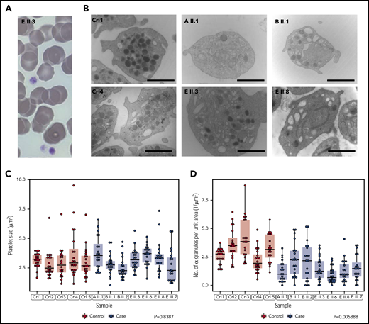 Cases have normally sized platelets but reduced numbers of α granules. (A) Representative May-Grünwald-Giemsa stained peripheral blood smear of patient E II.3. Platelets have a normal appearance (size and granularity) by light microscopy (magnification ×100). (B) Representative EM images for 2 unrelated healthy controls and 4 patients from pedigrees A, B, and E showing depletion of α granules. Marker is 1.5 μM for magnification x20 000. (C, D) The sizes and quantities of α granules per unit area of 20 platelets, quantified blinded to case/control status, in each of 5 cases and 7 controls. Linear mixed model with a fixed effect for case/control status, a random effect for pedigree (groupings in gray) and a random effect for sample. The P value under the null hypothesis that the fixed effect is equal to 0 is shown for each of the 2 responses.