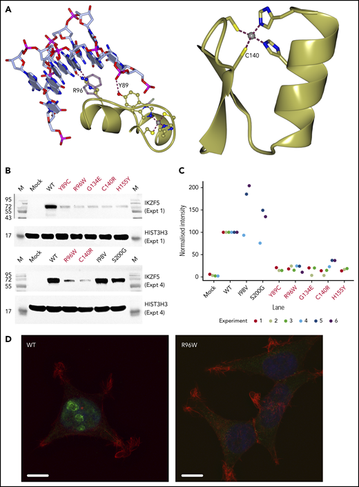 Structural modeling of the variants and expression studies in HEK293 cells. (A) Left panel: Mutation sites in Znf 1 of IKZF5. The structure of Znf 4 from CTCF (PDB entry 5kkq33) is portrayed as a template to understand the effect of the mutations Y89C (site equivalent to Y358) and R96W (site equivalent to K365). To model the conformation of R96, K365 in the CTCF structure was replaced by an arginine in a similar conformation to that of R369 in PDB entry 5kl6.34 WT side chains are shown in ball-and-stick representation, whereas the mutated side chains are shown as partially transparent cylinders. Right panel: The role of C140 in Znf 3. We used the coordinates for Znf 6 from PDB entry 5kkq without any changes as all the side-chains shown are conserved between the 2 sequences. (B) Western blot analysis of HEK293 transfected cells with myc-tagged IKZF5 WT and mutants after extraction of chromatin-bound proteins. HIST3H3 (histone H3) serves as loading control. HEK293 transfected with empty vector (Mock) express no IKZF5. The 5 causal mutants are highlighted in red. (C) Quantification of chromatin-bound IKZF5 after transfections and normalization against HIST3H3. The 5 causal mutants are highlighted in red. (D) Immunofluorescence (z-stack images by a structured illumination microscope) using an antibody against IKZF5 (green), phalloidin (actin; red), and 4′,6-diamidino-2-phenylindole (nucleus, blue) showing punctate, nuclear staining for WT IKZF5, whereas R96W and other mutants (supplemental Figure 4) remain largely outside the nucleus after transfecting HEK293 cells. Scale bar, 10 µm.