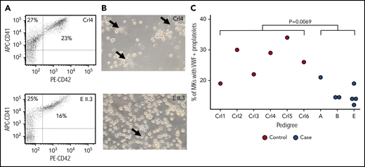 Reduced PPF in MKs from cases. (A) Flow cytometry analysis of day 10 MK for markers CD41 and CD42 showed no difference in maturation between control and case MKs. (B) The same cultures showed evidence of reduced PPF (arrows). (C) PPF was quantified after MK spreading on fibrinogen and staining for VWF for 6 unrelated controls and 7 cases. Linear mixed model with a fixed effect for case/control status, a random effect for pedigree and a random effect for sample. The P value under the null hypothesis in which that the fixed effect is equal to 0 is shown.