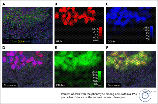 Macroscopic view showing zonal distribution of CTLA-4–positive cells, HRS cells, and CD86-positive cells. (A) Four 20× fields of view merged to form a macroscopic mIF image from a representative case of cHL (CHL12). (B) Phenotypic cell fraction represented as a spatially distributed heatmap for HRS cells. (C) Phenotypic cell fraction represented as a spatially distributed heatmap for CD86-positive cells. (D) Composite heatmap for HRS cells and CD86-positive cells (purple, colocalization of HRS cells and CD86-positive cells) overlaid on the original mIF image in panel A. (E) Phenotypic cell fraction represented as a spatially distributed heatmap for CTLA-4–positive cells. (F) Composite of heatmaps for HRS cells and CTLA-4–positive cells (yellow, colocalization of HRS cells and CTLA-4–positive cells) overlaid on the original mIF image (from panel A). The color intensities for each heatmap were determined by calculating percentage of cells with the given phenotype among all cells within a 49.6 µm radius distance of the centroid of each hexagon. DAPI, 4′,6-diamidino-2-phenylindole.