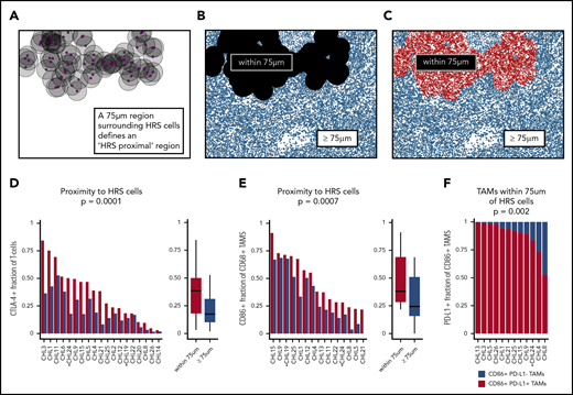 The HRS cell microenvironmental niche is enriched for CTLA-4–positive cells and CD86-positive TAMs. (A-C) Schematic showing generation of “HRS proximal” and distal regions in the representative case shown in Figure 4 (CHL12). (D) The HRS proximal region is enriched for T cells that are CTLA-4–positive (median percentage positive, 38%; range, 3%-84%) in each individual case, and across cases, relative to the distal region (median, 18%; range, 2%-53%; P = .0001). (E) The HRS proximal region is enriched for CD68-positive TAMs that are CD86-positive (median percentage positive, 38%; range, 22%-91%) in each individual case, and across cases, relative to the distal region (median percentage positive, 24%; range, 0%-69%; P = .0007). (F) The CD86-positive TAMs within 75 μm of HRS cells were predominantly PD-L1–positive (median percentage positive, 92%; range, 52%-99%) (PD-L1–positive vs PD-L1–negative, P = .002). EBV-positive cases are marked by asterisks.