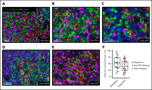 CTLA-4–positive cells are present after anti–PD-1 immunotherapy and focally contact HRS cells. Representative mIF images of core tissue biopsy samples from 3 patients with recurrent cHL after anti–PD-1 immunotherapy (A-C), from 1 patient after doxorubicin, bleomycin, vinblastine, and dacarbazine therapy (ABVD) (D), and from 1 patient after SCT (E), and showing the presence of CTLA-4–positive cells, including CTLA-4–positive T cells focally in contact with CD86-positive/PAX5-positive HRS cells. (F) Relapsed cHL cases (n = 18) have a large portion of HRS cells in contact with CTLA-4–positive cells (median, 54%; range, 13%-98%); this is greater (Mann-Whitney U test, P = .11) than the portion of HRS cells in contact with CTLA-4–positive cells among diagnostic cases (n = 20; median, 40%; range, 7%-76%). DAPI, 4′,6-diamidino-2-phenylindole.