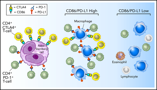 Model of PD-1:PD-L1 and CTLA-4:CD86 interactions in cHL. HRS cells (purple) express PD-L1 (and PD-L2) and CD86. TAMs (blue) that are in proximity to HRS cells frequently coexpress both PD-L1 and CD86, likely in response to local cytokine production, and thereby significantly increase the total amount of these ligands in proximity to the malignant cells. PD-L1 and CD86 on TAMs and HRS cells are available to bind PD-1–positive/CD4-positive T cells (green) and CTLA-4–positive/CD4-positive T cells (yellow). PD-1–positive T cells (previously shown)6 and CTLA-4–positive T cells are specifically enriched in the vicinity of PD-L1–positive/CD86-positive HRS cells.