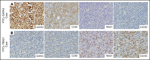 Selected IHC panel included in the diagnostic algorithm. (A) Positive immunostains for GATA3 (nuclear) and its corresponding target protein CCR4 (membranous) in a PTCL-GATA3 case. This case is negative for TBX21 and CXCR3. (B) Positive immunostains for TBX21 (nuclear) and its target protein CXCR3 (membranous) in a PTCL-TBX21 case. This case is negative for GATA3 and CCR4. (A-B) Original magnification ×600.