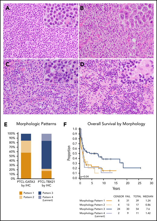 Representative morphologic patterns in PTCL subtypes. PTCL-GATA3 was significantly associated with a monomorphic, monotonous, tumor cell–rich morphology with a minimal inflammatory background characterized by: (A) small-intermediate cells with abundant cytoplasm (pattern 1) or (B) clusters or sheets of large cells (pattern 2). In contrast, PTCL-TBX21 was significantly associated with a polymorphous morphology, characterized by (C) neoplastic cells interspersed in a mixed inflammatory background (pattern 3) or (D) the classic lymphohistiocytic (Lennert) lymphoma morphology composed of small tumor cells within clusters of epithelioid histiocytes (pattern 4). (E) Distribution (percentage) of morphological patterns in the 2 PTCL subtypes with monomorphic patterns associated with PTCL-GATA3, whereas polymorphic patterns associated with PTCL-TBX21 (P < .001). (F) The monomorphic patterns (1 and 2) and the Lennert lymphoma pattern (pattern 4) were associated with worse OS, when both cohorts were combined. (A-D) H&E stain; original magnification ×200; inset magnification ×400.