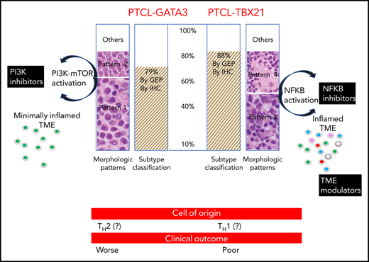 PTCL-GATA3 and PTCL-TBX21 subtypes were found in ∼85% of cases defined by IHC and GEP. PTCL-GATA3 was associated with monomorphic patterns (histologic patterns 1 and 2), whereas PTCL-TBX21 was associated with polymorphic patterns (histologic patterns 3 and 4). Monomorphic patterns (patterns 1 and 2) were morphologically characterized by a monotonous tumor cell morphology with a minimal inflammatory TME. CD4+ T-cell rich, polymorphic patterns (patterns 3 and 4) were characterized by polymorphic neoplastic cells interspersed in a mixed inflammatory TME (pattern 3) or in the classic TME of lympho-histiocytic (Lennert) lymphoma (pattern 4). In the polymorphic patterns, the inflamed TME was CD4+ and CD8+ T-cell rich and contained eosinophils, plasma cells, and histiocytes. The PTCL-GATA3 subtype was associated with PI3K-mTOR activation, whereas PTCL-TBX21 showed NF-κB activation. Therefore, PTCL-GATA3 subtype patients may benefit from PI3K inhibitors, whereas PTCL-TBX21 subtype patients may benefit from NF-κB inhibitors and TME modulators. Significant differences in overall survival were observed between the PTCL-GATA3 and PTCL-TBX21 subtypes derived by IHC and GEP classification (not shown). CD4+ T cell CD8+ T cell eosinophil plasma cell histiocyte. The figure has been adapted from Figure 5 in the article by Amador et al that begins on page 2159.