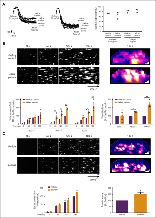 In vitro aggregation of platelet from NSML patients and ex vivo thrombus formation of blood from NSML patients or treated with SHP2 inhibitor. (A) Platelets from healthy controls and NSML patients were stimulated with collagen (0.75 and 3.3 µg/mL). Platelet aggregation curves of a representative healthy control and from each of the 3 NSML patients are shown. Graph represents the percentage of maximal aggregation of 3 healthy controls and 3 NSML patients. Each point corresponds to an individual. Patient 1 is represented in green, patient 2 in red, and patient 3 in blue. (B) Anticoagulated human whole blood, where platelets were labeled with DiOC6, was perfused through Cellix Vena8 Fluoro+ biochips at different shear rates on fibrillar collagen matrix over 3 minutes. Thrombus formation was visualized in real time by videomicroscopy. Shown are representative 2- and 3-dimensional images of NSML patient 2 blood perfusion at a stenosis shear rate of 3000 s−1 obtained after processing with ImageJ and Imaris software, respectively (scale bar, 20 μm). Surface covered by platelets and thrombus volume were quantified at different shear rates (500, 1500, and 3000 s−1) by using ImageJ software. Graphs represent mean ± SEM for 3 healthy controls and 3 NSML patients. For NSML patients, each point corresponds to an individual (patient 1 is represented in green, patient 2 in red, and patient 3 in blue). (C) Anticoagulated human whole blood treated with SHP099 (10 μM) or its vehicle, dimethyl sulfoxide, for 2 hours and labeled with DiOC6 was perfused through Cellix Vena8 Fluoro+ biochips at 1500s−1 on fibrillar collagen matrix over 3 minutes. Thrombus formation was visualized in real time by videomicroscopy. Shown are representative 2- and 3-dimensional images of blood from 7 healthy donors. Surface covered by platelets and thrombus volume were quantified by using ImageJ software. Graphs represent mean ± SEM for 7 healthy donors. *P < .05, **P < .01, ***P < .001 vs healthy controls according to 2-way ANOVA and 1-sample t test. †P < .001 vs vehicle according to 1-sample t test.
