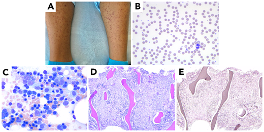 A 17-year-old boy with obsessive-compulsive disorder, limited dietary variety, and back and leg pain was referred to the emergency department with concern for an infiltrative process after magnetic resonance imaging showed abnormal bone marrow signal. On examination, he was found to have gingival inflammation and a perifollicular petechial rash on his lower extremities (panel A). Initial laboratory results revealed a normocytic anemia (hemoglobin 10.3 g/dL), and a blood smear was devoid of blasts, dacrocytes, dysplasia, and polychromasia (panel B; Wright-Giemsa stain, original magnification ×200). The marrow aspirate revealed trilineage hematopoiesis with erythroid hyperplasia (panel C; Wright-Giemsa stain, original magnification ×500). The core biopsy demonstrated atrophic changes, relative erythroid hyperplasia (panel D; hematoxylin and eosin stain, original magnification ×50), and no reticulin fibrosis (panel E; reticulin stain, original magnification ×50). Limited genetic testing was negative. Subsequently, nutritional laboratory results revealed several critically low vitamin levels, most notably an undetectable plasma vitamin C level. The patient was diagnosed with scurvy and started on vitamin C replacement and had notable improvement in his pain, rash, and gingival hyperplasia within days of initiation.