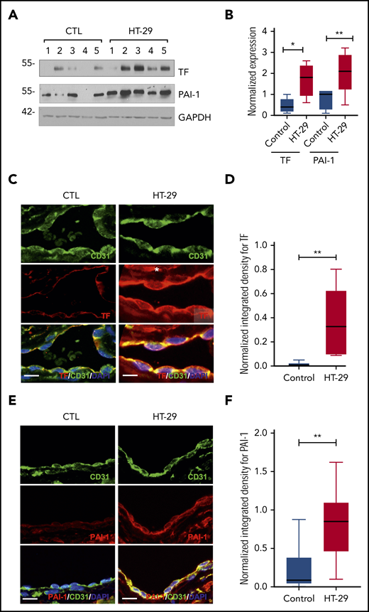 Increased TF and PAI-1 in the IVC of animals with colon cancer xenografts. (A) IVC from mice shown in Figure 4A were harvested, divided for immunoblotting, and fixed for immunofluorescence microscopy. Of 8 mice per group, the lysates from 5 mice were resolved on sodium dodecyl sulfate–polyacrylamide gel electrophoresis gels due to sufficient quantity of protein in these samples. Equal amounts of samples were separately probed on different western blots with the indicated antibodies (owing to proximity of bands). Glyceraldehyde-3-phosphate dehydrogenase (GAPDH) served as a loading control. (B) The immunoblot bands of TF and PAI-1 shown in Figure 4A were normalized to GAPDH in the aforementioned gel. Normalized TF and PAI-1 from control and HT-29 mice are shown on box plots. Asterisks (* and **) compare the expression of TF and PAI-1, respectively, between the 2 groups. *P = .032 and **P = .0425. (C) Increased expression of TF in the IVC of animals with colon cancer xenografts. IVC from animals with a xenograft without IVC ligation were stained by using anti-TF and anti-CD31 antibodies. Alexa Fluor secondary antibodies were used. 4′,6-Diamidino-2-phenylindole (DAPI) was used for nuclear stain. Un-injected animals served as controls (CTL). Images are representative of IVCs from 8 mice in each group. Scale bar = 10 μm. (D) Three images per IVC were analyzed, and a region of interest was marked corresponding to the endothelial cells. Integrated density was normalized to the surface area of the region of interest measured in microns by using ImageJ. Data are presented as a box plot, and the Student t test was used to compare the 2 groups. **P = .002. (E) Increased expression of PAI-1 in the IVC of animals with colon cancer xenografts. IVCs from animals with xenografts without IVC ligation, as described earlier, were stained by using anti–PAI-1 and anti-CD31 antibodies. Images are representative from 8 mice in each group. Scale bar = 30 μm. (F) Integrated density for PAI-1 was performed as noted earlier. The data are presented as a box plot, and the Student t test was used to compare the 2 groups (**P = .009).