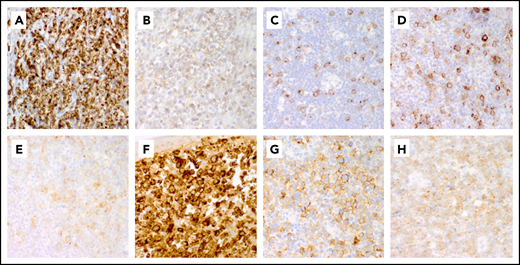 Representative patterns of CD30 expression in non-ALCL T-cell lymphomas. (A-C) Variable expression patterns of CD30 in PTCL-NOS. Strong uniform CD30 expression in PTCL-NOS (A), weak CD30 expression in PTCL-NOS (B), and partial CD30 expression in PTCL-NOS (C). (D-E) CD30 expression in AITL. (D) CD30 is expressed in large immunoblasts and in smaller neoplastic cells in AITL. (E) Weak CD30 expression in AITL. (F) Transformed mycosis fungoides with strong diffuse CD30 expression. (G-H) Patterns of expression of CD30 in ENKTL. Moderate partial CD30 expression in ENKTL (G) and diffuse weak CD30 expression in ENKTL (H). Original magnification ×50 for all panels.