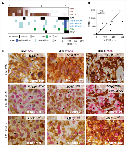 Expression of β2M, MHC class I, and MHC class II proteins affected by different genetic alterations. (A) Tumor-specific protein expression for β2M, MHC class I, and MHC class II is visualized as color-coded H-score (intensity × percent positive) for all 28 PMBLs with available immunohistochemistry (IHC) data (brown, top panel). Genetic alterations in B2M, MHCI/MHCII, CIITA, and EZH2 color coded by alteration type (key below). Cases depicted in (C) indicated on top with an asterisk, section symbol, and pound sign. (B) Correlation of H-scores of MHC class I and β2M. P values were obtained by using a Spearman correlation test. (C) Representative examples of cases with positive expression of β2M, HLA class I, and HLA class II (top); absence of β2M, HLA class I expression, and decreased HLA class II expression (middle); and absent β2M, HLA class I expression, and positive HLA class II expression (bottom). H-score, lower right corner; genotype, upper right corner. Arrow heads indicate region of interest. Scale bar = 20 μm. del, deletion; mut, mutated; wt, wild-type.