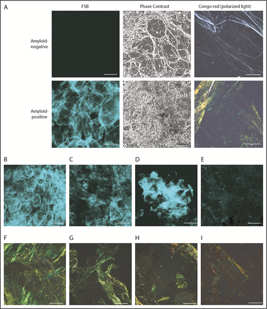 Figure 1. Representative amyloid-positive and -negative subcutaneous abdominal samples, stained with the CR–derivative FSB. (A) Paired images from amyloid-positive and amyloid-negative samples, acquired under confocal microscopy and phase-contrast analysis. (B-E) Distinct patterns of amyloid deposition (corresponding CR-PL images are visible, respectively, in panels F-I). (B) Pericellular distribution (ALλ patient). (C) Diffuse interstitial distribution (ALλ patient). (D) Focal interstitial (ATTRwt patient). (E) Tiny scattered amyloid foci (ALλ patient). Scale bars, 100 μm in all FSB panels; 200 μm in all CR panels. In the pericellular type, amyloid is distributed around cells and defines the contour of the adipocytes, whereas the interstitium is not enlarged. In contrast, in diffuse and focal interstitial types, large (widespread or localized, respectively) accumulations of amyloid are seen between cells. In the last type (E), tiny amyloid deposits are scattered across the sample in the interstitial space and within vessels.