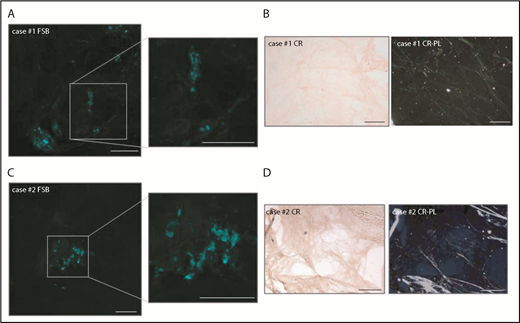 Figure 2. Details of the 2 FSB+/CR−adipose tissue samples. (A,C) FSB-stained tissue from cases 1 and 2, respectively (low magnification images and enlarged insets). (B,D) CR-stained tissue from cases 1 and 2, respectively (left, nonpolarized light; right, polarized light). Scale bars, 200 μm.