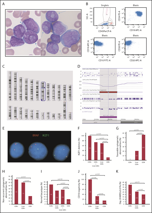 Figure 1. Morphologic, immunophenotypic and cytogenetic features of precursor B-ALL with CLN. (A) CLN (arrows) in variably sized blasts in BM smears from cases 1 and 2 (Wright-Giemsa stain, original magnification ×1000). (B) Representative immunophenotype of CLN+ B-ALL cases: CD34+CD19+CD20−CD10− or CD10 dimly and partially positive. Dot plots of 4-color FCM analysis performed using a BD FACSCanto and analyzed with BD FACSDiva software. (C) Image of Affymetrix CytoScan HD whole-genome microarray showing 7p12.2 deletion as the sole clonal aberration (red arrow). (D) Zoomed in image of the 7p12.2 deletion showing loss of the entire IKZF1 gene. (E) FISH image showing a single green signal for IKZF1 in the first 2 cells (from left to right), which indicates 1 copy loss of IKZF1. The 2 red BRAF (7q34) signals serve as an internal chromosome 7 control. Comparison of CLN+, low-CLN+, and CLN− frequencies with IKZF1 deletion (F), favorable cytogenetic abnormalities (ETV6/RUNX1 or high hyperdiploidy) (G), nonrecurrent cytogenetic abnormalities (H), normal karyotype (I), CD10 negativity or partial negativity (J), and day-29 BM MRD ≥ 0.01% (K).
