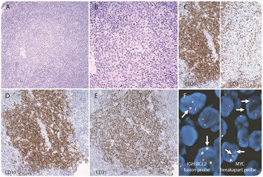 A 93-year-old woman presented with axillary lymphadenopathy. A biopsy showed lymphoid tissue with vaguely nodular architecture. Within the nodule, there was sheet of exclusive large centroblasts with few centrocytes in between (panels A-B; hematoxylin and eosin stain, original magnification ×200 and ×400, respectively). By immunohistochemistry, the cells were positive for CD20/CD3 (panel C; original magnification ×200), CD10 (panel D; original magnification ×400), BCL6, BCL2, and MYC protein. CD21 highlighted the intact follicular dendritic meshwork (panel E). Ki-67 proliferation index increased to 80% to 90%. The diagnosis of follicular lymphoma (FL) 3b/3 was made. Fluorescent in situ hybridization identified both BCL-2 and MYC gene rearrangements (panel F; original magnification ×1000). Thus, this case represented so-called double-hit FL (DH-FL). / De novo DH-FL is very rare and has been reported to be associated with a higher histologic grade, with few exceptions. The prognostic significance of DH-FL is still controversial. One study reported aggressive behavior, but suggested better response to more intensive treatment, whereas other reports revealed a regular behavior similar to that of conventional FL that lacks MYC rearrangement. Although double-hit diffuse large B-cell lymphoma has been recognized as high-grade B-cell lymphoma with MYC and BCL2 and/or BCL6 rearrangements by the new World Health Organization classification, DH-FL is not included in this category. More investigations are needed to better characterize its clinicopathological features.