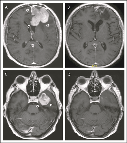 Figure 2. Examples of responses to R-CHOP preceded by NGR-hTNF. (A) Gadolinium-enhanced T1 weighted scan shows a large homogeneous enhancing lesion in the left frontal lobe (arrows) in a 62-year-old woman at the second relapse after high-dose methotrexate and after salvage high-dose ifosfamide-based therapy; disease was refractory to previous lines. (B) Tumor regression after 2 courses of experimental treatment. (C) Gadolinium-enhanced T1 weighted scan shows a large enhancing left temporal lesion (arrows) in a 65-year-old man at the second relapse after high-dose methotrexate and after salvage whole-brain irradiation. (D) Tumor regression after 2 courses of experimental treatment.