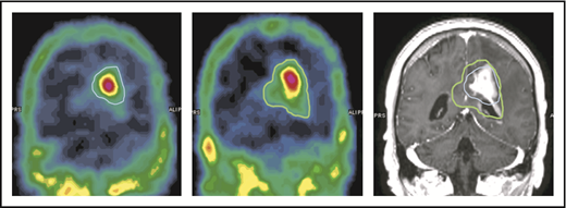 Figure 5. An example of increase of 99mTc-DTPA uptake after the infusion of NGR-hTNF followed by R-CHOP at the third course of treatment. The volume of ≥30% 99mTc-DTPA uptake is contoured in 2 SPECT studies performed before (left image, blue line) and after (middle image, green line) administration of NGR-hTNF and R-CHOP. Comparison of contoured volumes are represented in the gadolinium-enhanced T1-weighted MRI showing the tumor (right image). The volume of interest before and after NGR-hTNF/R-CHOP delivery was 22 cm3 and 40 cm3, respectively.