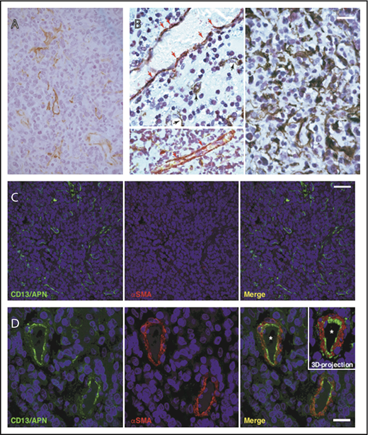 Figure 6. Expression of CD13 by tumor vasculature. (A) Immunohistochemical analysis of CD13 expression within the lymphomatous component of diagnostic brain biopsy sample of an enrolled patient. Staining was performed by using the anti-CD13 monoclonal antibody SP187 alone (brown signal, 400×). (B) Immunohistochemical analysis of CD13 and αSMA (a marker of pericytes). The costaining was performed with the anti-CD13 monoclonal antibody SP187 (brown) and the anti-αSMA monoclonal antibody 1A4 (red). Black arrows indicate CD13-positive vessels; red arrows indicate αSMA-positive perivascular cells (scale bar, 20 µm; 630×). Left panels: representative photograph of areas with large vessels with pericyte coverage (red) and some microvessels, showing CD13 staining (brown) also in the absence of pericytes. Right: representative photograph of an area with several CD13-positive structures, likely corresponding to microvessels (brown). (C-D) Confocal immunofluorescence analysis of a tissue section stained with a polyclonal anti-CD13 antibody (green) and with the anti-αSMA antibody 1A4 (red) (400×; scale bar, 50 µm). Inset: Three-dimensional projection of CD13 and αSMA staining of a mature vessel (asterisk) (400×; scale bar, 25 µm) showing that CD13 was expressed on the luminal side of the vessels.
