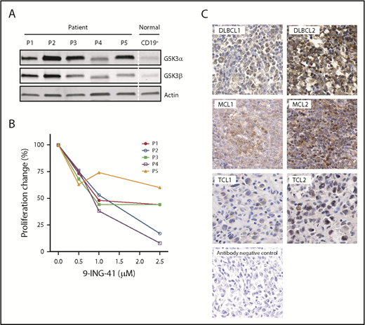 Figure 6. Aberrant expression of GSK3 proteins in primary lymphoma patient (P) cells and their proliferative response to 9-ING-41. (A) Immunoblot of GSK3α and GSK3β proteins showing overexpression in patient samples vs normal B-cell control. P1, MCL; P2, high-grade B-cell lymphoma; P3, follicular large B-cell lymphoma 3B; P4, DLBCL; and P5, angioimmunoblastic T-cell lymphoma. (B) 9-ING-41 inhibited proliferation in all 5 patient samples. (C) Immunohistochemistry staining of GSK3β on paraffin tissue sections from patients with various lymphomas (original magnification ×40). Representative images show the spectrum of GSK3β (brown) overexpression in different lymphoma samples. Methylene blue counterstaining (blue) reveals cells negative for GSK3β in the background and in the antibody negative-control panel.