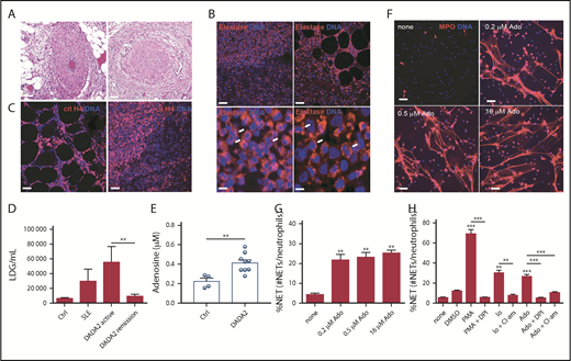 Figure 1. NETs are present in DADA2-affected tissue and adenosine induces NET formation through NOX- and PAD-dependent pathways. (A) Hematoxylin-and-eosin (H&E) staining of small bowel tissue obtained from a patient with DADA2 shows neutrophilic infiltration in the wall of mesenteric arteries. (B) Neutrophil (arrows) infiltration in the appendix of a patient with DADA2. Red represents neutrophil elastase and blue is Hoechst. Scale bar, 100 µm. (C) Detection of NETs in a biopsy from a patient with DADA2. Red represents citrullinated histone H4 and blue is Hoechst. Scale bar, 100 µm. (D) LDGs were identified in patients with DADA2. LDGs per milliliter were significantly more abundant in patients with DADA2 during periods of disease activity (active, n = 4; remission, n = 10). LDGs from control (Ctrl; n = 2) and patients with SLE (n = 9) were used for comparison. (E) Adenosine levels were measured in plasma from patients with DADA2 (n = 9) and controls (n = 4). (F-G) Control neutrophils were incubated with different concentrations of adenosine (Ado) for 3 to 4 hours. Immunofluorescence shows that adenosine induces NET formation in control neutrophils, blue represent Hoechst; red is myeloperoxidase (MPO). Scale bar, 50 µm. Results are expressed as percentage of NETs (number of NETs/total number of neutrophils + NETs). **P < .01, Mann-Whitney U test. Results are the means ± standard error of the mean (SEM) of 4 independent experiments. (H) Control neutrophils were incubated in the presence or absence of NOX inhibitor (DPI; 5µM) or pan-PAD inhibitor (Cl-amidine, Cl-am; 20 µM) and stimulated with 16 µM adenosine (Ado). Phorbol myristate acid (PMA; 100 ng/mL) and calcium ionophore (Io; 2.5 µM) were used as positive controls. Results are expressed as percentage of NETs (number of NETs/total number of neutrophils + NETs). **P < .01, ***P < .001, Mann-Whitney U test. Results are the means ± SEM of n = 6. DMSO, dimethyl sulfoxide.