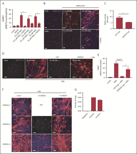 Figure 2. ADA2 decreases adenosine-induced NETs. Control neutrophils were incubated with different concentrations of adenosine (Ado) and in the presence or absence of 100 ng of recombinant ADA2 for 3 to 4 hours. (A) Percentage of NETs were graphed (number of NETs/total number of neutrophils + NETs). Results are the means ± SEM of n = 4, *P < .05, Mann-Whitney U test. (B) Representative confocal images after treatment with recombinant ADA2. Blue represents Hoechst; red is myeloperoxidase (MPO). Control neutrophils were incubated in the presence or absence of supernatant from control macrophages or DADA2 macrophages in the presence of adenosine. Scale bar, 50 µm. (C) ADA2 activity was measured in supernatants from control and DADA2 macrophages after 48-hour incubation. Results are the means ± SEM of n = 4, *P < .05, Mann-Whitney U test. (D) Representative confocal image of neutrophils treated with adenosine in the presence of macrophage supernatant from healthy volunteers or patients with DADA2. Scale bar, 50 µm. (E) Percentage of NETs were graphed (number of NETs/total number of neutrophils + NETs). Results are the means ± SEM of n = 3 to 4, *P < .05, Mann-Whitney U test. (F) Confocal images of DADA2 neutrophils treated with adenosine (Ado) in the presence or absence of human 100 ng of recombinant ADA1 (hrADA1) or ADA2 (hrADA2) for 3 to 4 hours. Blue represents Hoechst; red is myeloperoxidase (MPO). Scale bar, 50 µm. (G) ADA1 activity was measured for the human recombinant ADA1 used. N.D., not determined.