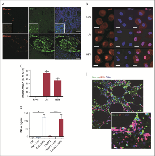 Figure 5. NETs promote NF-κB nuclear translocation and stimulation of TNF-α release from macrophages. (A) Neutrophils and TNF-α were detected in tissue from a patient with DADA2. Red represents elastase; green is TNF-α; and blue is Hoechst. Scale bar, 100 µm. Control macrophages were incubated in presence of spontaneously generated NETs from LDGs or normal dense neutrophils from DADA2 patients or lipopolysaccharide (LPS) for 45 minutes to 2 hours. (B-C) Translocation of the NF-κB subunit p65 was assessed by immunofluorescence and quantified. LPS was used as positive control. Scale bar, 10 µm. (D) Levels of TNF-α in supernatants from control and DADA2 macrophages incubated with NETs for 48 hours were analyzed by enzyme-linked immunosorbent assay (ELISA). *P < .05, **P < .01, ****P < .0001, Mann-Whitney U test. Results are the means ± SEM of 6 independent experiments. (E) Macrophages and NETs detected in appendix tissue from a patient with DADA2. Red represents citrullinated histone H4; green is a marker for macrophages; and blue is Hoechst. Scale bar, 10 µm.
