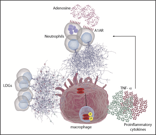 Figure 7. Schematic representation of the role of neutrophil and macrophages in DADA2. Due to the lack of ADA2 activity in patients with DADA2, extracellular adenosine may accumulate. Elevated concentrations of adenosine can engage A1AR and/or A3AR in neutrophils leading to NET formation. In addition, LDGs present in patients with DADA2 release NETs spontaneously. Both sources of NETs can activate macrophages, leading to NF-κB translocation to the nucleus and activation of proinflammatory cytokines such as TNF-α and IL-6, among others. In turn, TNF-α can prime neutrophils to undergo further NETosis, leading to a vicious cycle.