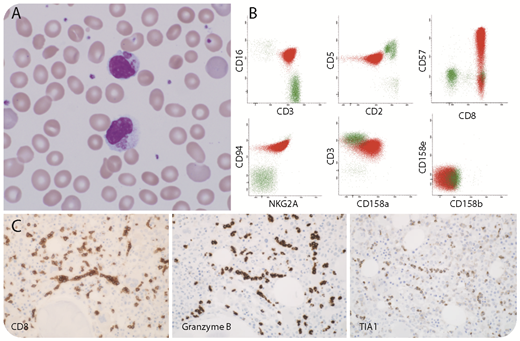A 54-year-old man presented with shortness of breath and light-headedness. Complete blood count (CBC) showed anemia (hemoglobin, 5.0 g/dL) and lymphocytosis (lymphocyte count, 7.9 × 109/L). Peripheral blood smears (panel A; original magnification ×1000, hematoxylin and eosin stain) showed increased large granular lymphocytes (7.3 × 109/L) with giant reddish-purple cytoplasmic inclusions. Flow cytometry (panel B) revealed CD3+CD8+ T cells (77% of total events) with dim expression of CD2 and CD5 and coexpression of natural killer cell–associated markers CD16, CD57, CD94, and NKG2A. Clonality was established by restricted killer-cell immunoglobulin-like receptor CD158a and clonal T-cell receptor gene rearrangement. STAT3 mutation was detected. Bone marrow biopsy (panel C; original magnification ×400, immunohistochemical stain) showed intrasinusoidal infiltrates of CD8+, granzyme B+, and TIA1+ T cells. T-cell large granular lymphocytic leukemia (T-LGLL) was diagnosed, and cyclophosphamide was administered. CBC normalized upon 5 months of treatment and no cytoplasmic inclusions were identified in the subsequent smears, indicating an excellent response to therapy. / T-LGLL is an indolent disorder of persistent cytotoxic T-cell expansion with coarse/fine cytoplasmic azurophilic granules containing cytolytic proteins. The giant cytoplasmic inclusions are rarely seen in T-LGLL, likely representing a substantial accumulation of cytolytic proteins in the setting of acute presentation. The inclusions subsided after therapy, underscoring their association with disease status. Recognizing this phenomenon in T-LGLL is important for accurate diagnosis and treatment.