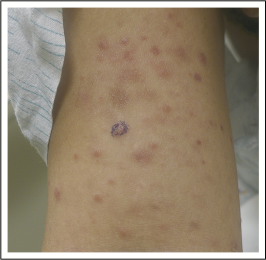 Figure 1. LyP. Erythematous papules in various stages of healing, with evidence of postinflammatory hyperpigmentation and early scarring.