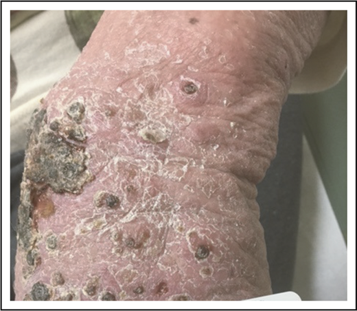 Figure 3. Necrotic LyP. Extensive coalescing papules with overlying hemorrhagic crust.