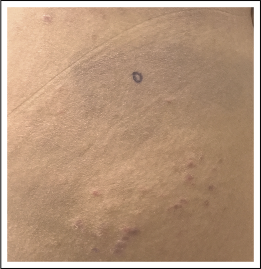 Figure 4. LyP and mycosis fungoides. Thin erythematous patches of MF that are distinct from the concurrent erythematous papules of LyP.