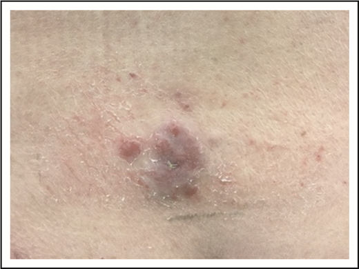Figure 5. PCALCL. An ulcerated plaque on the low back. Note incidental overlying dermatitis from adhesive bandages.