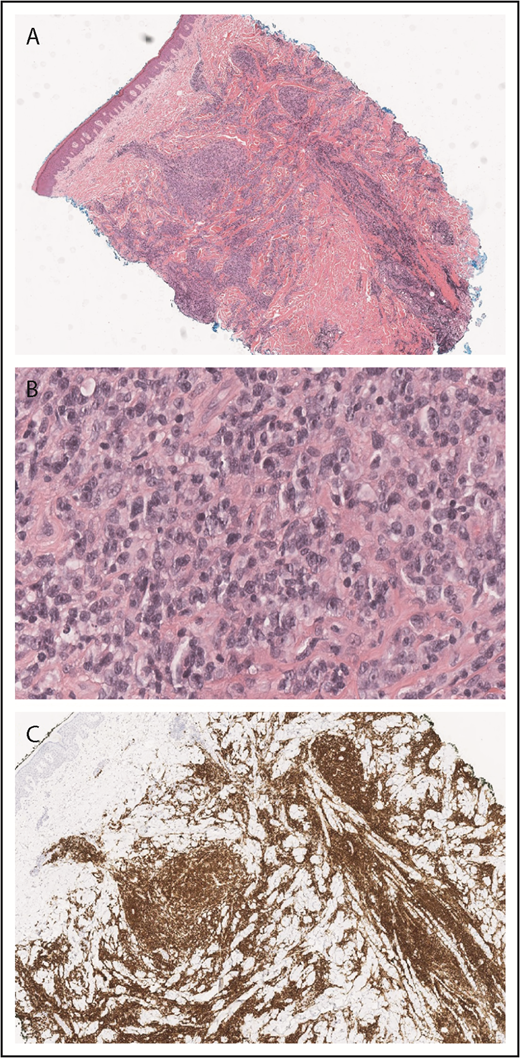 Figure 6. PCALCL histopathology. Diffuse dermal infiltrate of large, atypical lymphoid cells that are CD30 positive (A, H&E original magnification ×2; B, original magnification ×40; C, CD30, original magnification ×4).